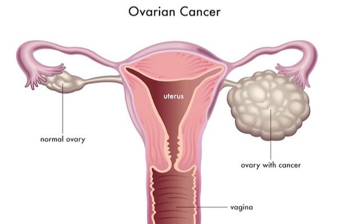 Ung thư buồng trứng giai đoạn 3 điều trị như thế nào? - 1