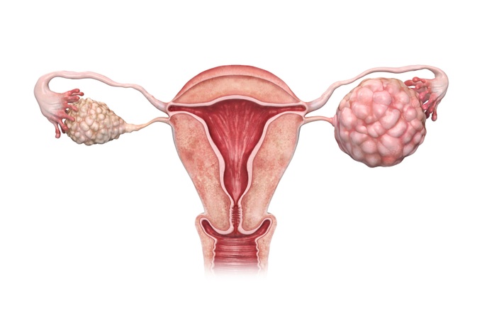 Dấu hiệu ung thư buồng trứng giai đoạn đầu - 1