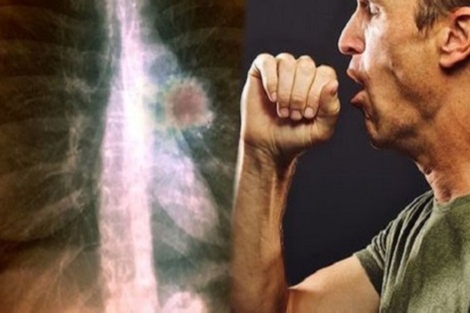 Những yếu tố nào ảnh hưởng đến thời gian sống của người bị u phổi ác tính?
