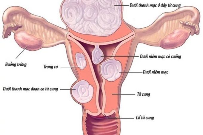 Bị u xơ tử cung có cần phải phẫu thuật? - 1