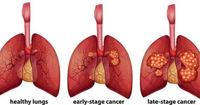 Ung thư phổi giai đoạn 4: Tiên lượng, dấu hiệu nhận biết