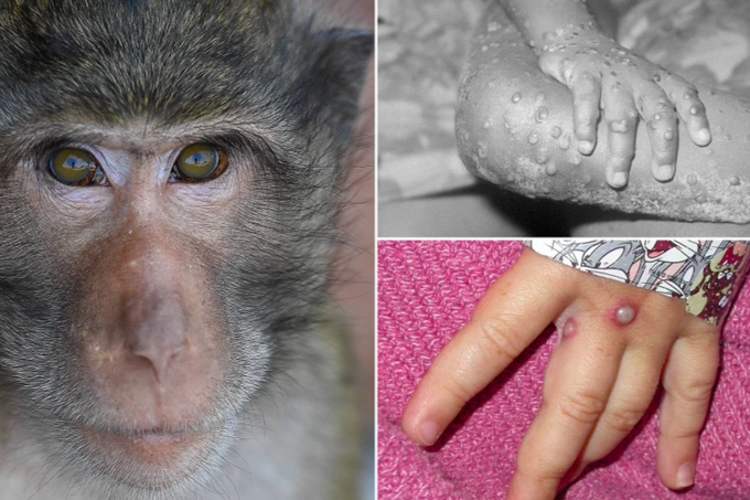 Theo dõi triệu chứng 4 giai đoạn từ nhẹ đến nặng của bệnh đậu mùa khỉ | Báo  Dân trí