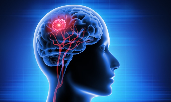 Có mấy loại u não ác tính và khác nhau như thế nào?
