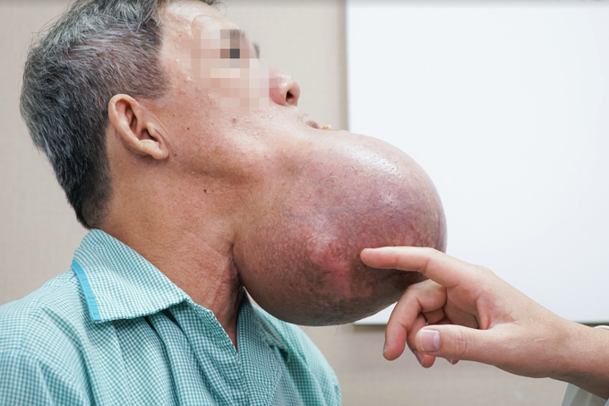 Người đàn ông nguy kịch vì khối u to bằng đầu sắp nổ tung dưới miệng - 1