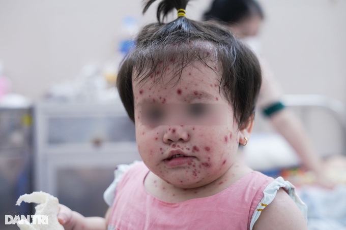 Nóng: Tay chân miệng tại Hà Nội vượt mốc 1.000 ca, có trường hợp thở máy - 2 Nóng: Tay chân miệng tại Hà Nội vượt mốc 1.000 ca, có trường hợp thở máy - 2