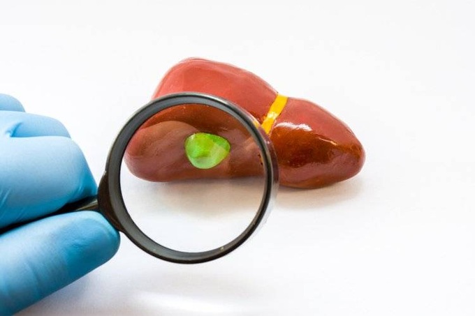 Phát hiện polyp túi mật liệu có nguy cơ tiến triển thành ung thư?