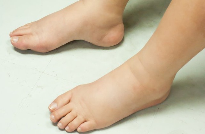Người bệnh ung thư cần làm gì khi bị phù nề, cổ trướng - 1 Người bệnh ung thư cần làm gì khi bị phù nề, cổ trướng - 1