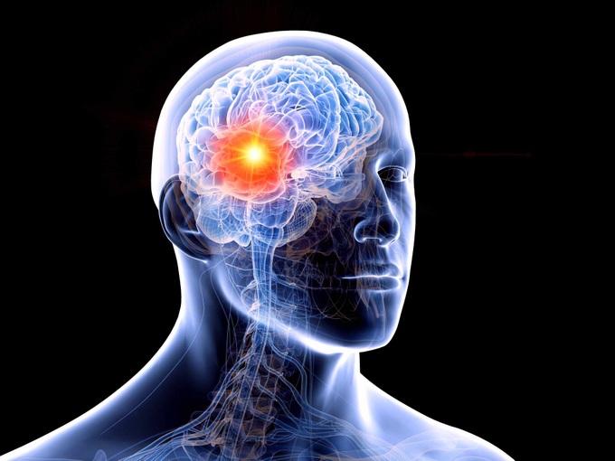 Khối u trực não có liên quan đến u não không?