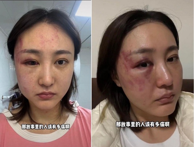 Hot girl nổi tiếng mạng xã hội cầu cứu dân mạng vì bị chồng bạo hành