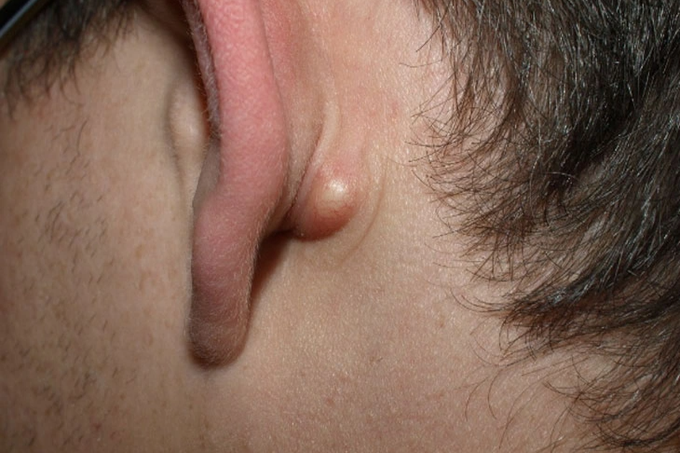 Nổi hạch sau tai: Trường hợp nào là dấu hiệu ung thư - 1
