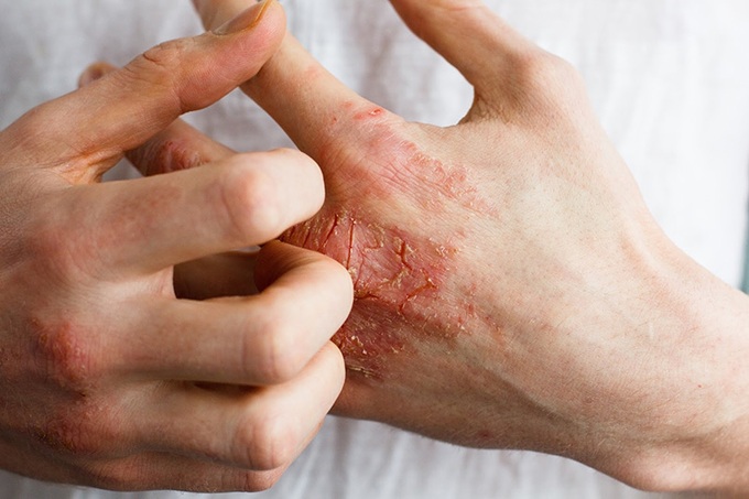 Những bệnh ngoài da thường gặp sau bão lũ và cách điều trị - 4