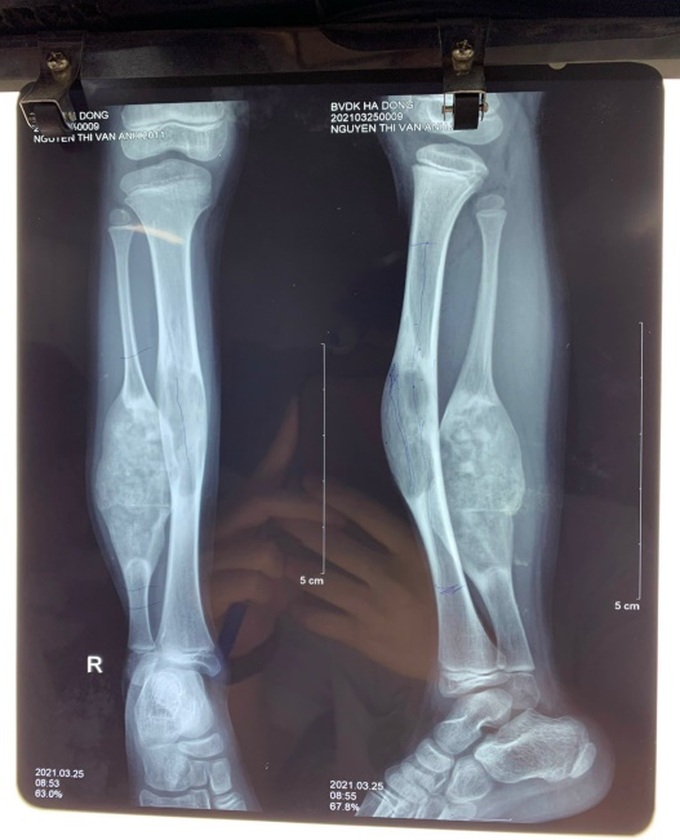 Bị đau chân, bé gái 10 tuổi phát hiện u xương chày dài 12cm - 1