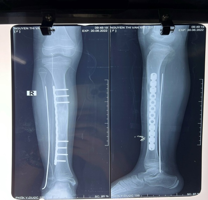 Bị đau chân, bé gái 10 tuổi phát hiện u xương chày dài 12cm - 2