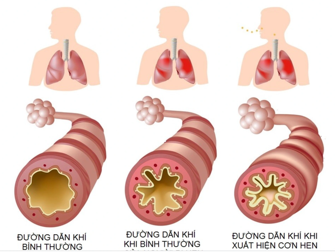 4.000 người Việt tử vong mỗi năm vì hen phế quản