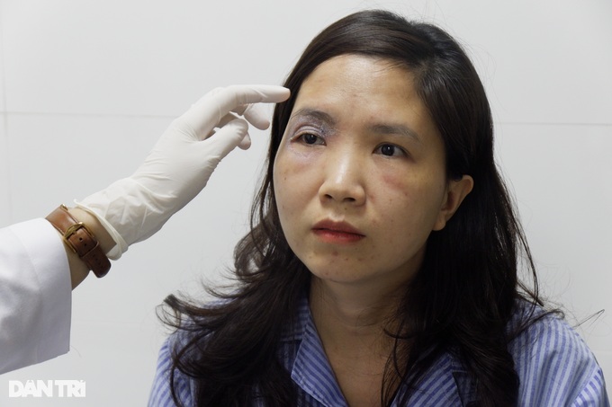 Hà Nội: Kiến ba khoang vào mùa, nhiều người nhập viện vì sưng mắt, loét da