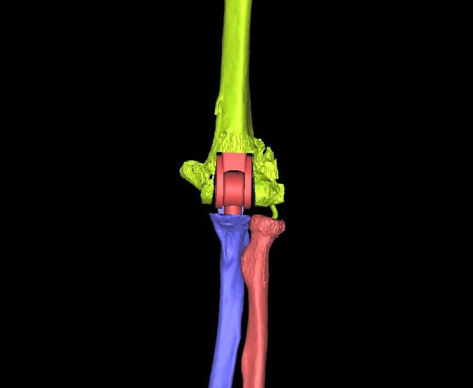 Cánh tay biến dạng được hồi phục nhờ công nghệ 3D - 2