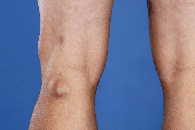 Khớp gối đột nhiên căng phồng: Cảnh giác với căn bệnh này