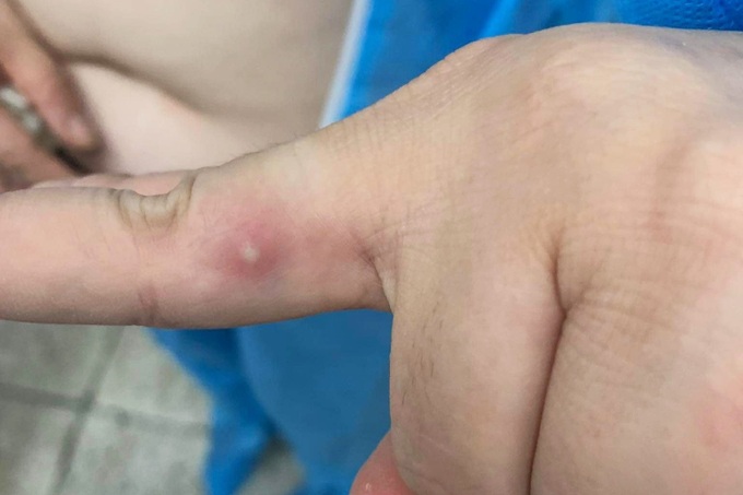 Ca đậu mùa khỉ thứ 2 tại Việt Nam tiếp xúc gần bạn trai có biểu hiện bệnh - 2