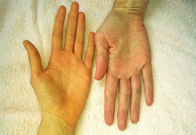 5 triệu chứng cảnh báo ung thư nhưng dễ bị bỏ sót - 5 5 triệu chứng cảnh báo ung thư nhưng dễ bị bỏ sót - 5