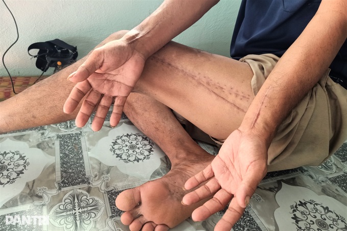 Vợ nghèo gánh nợ trăm triệu, lo chồng tháo khớp chân, 2 con thất học - 2 Vợ nghèo gánh nợ trăm triệu, lo chồng tháo khớp chân, 2 con thất học - 2