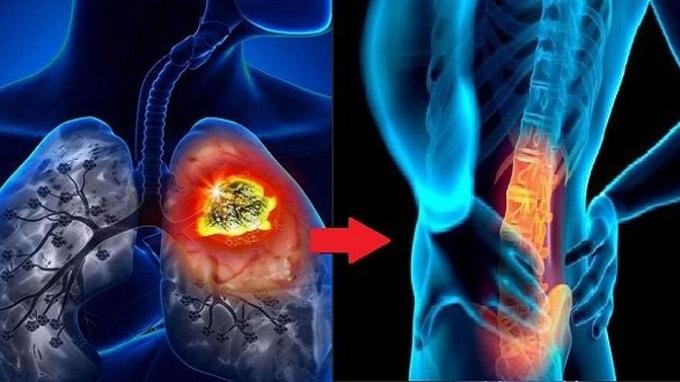 Triệu chứng cảnh báo ung thư phổi di căn xương - 1