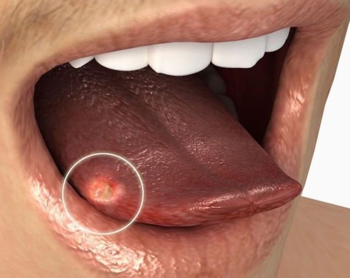 Nếu phát hiện triệu chứng u lưỡi, cần liên hệ với bác sĩ ngay hay không?