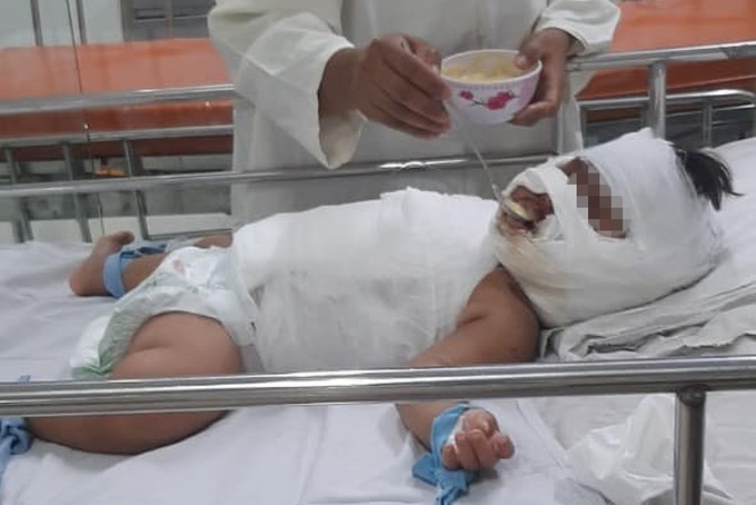 TPHCM: Bé gái 1 tuổi bỏng thương tâm vì ngã vào nồi nước sôi mẹ nấu - 2 TPHCM: Bé gái 1 tuổi bỏng thương tâm vì ngã vào nồi nước sôi mẹ nấu - 2