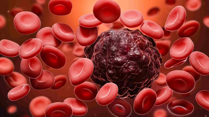 Ung thư máu giai đoạn cuối diễn biến như thế nào?
