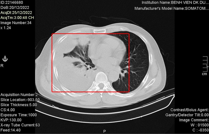 Hà Nội: Cựu F0 phổi bị đông đặc, hoại tử do di chứng Covid-19 - 1