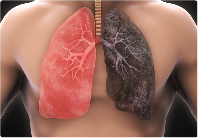 Nhiều người trong gia đình cùng mắc ung thư phổi: Bệnh có thể lây? - 1