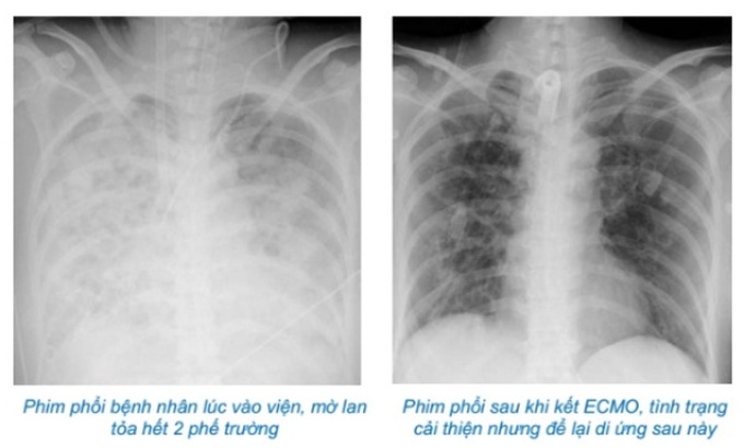 Mắc bệnh nhẹ thành nặng chỉ vì lạm dụng loại thuốc phổ biến này