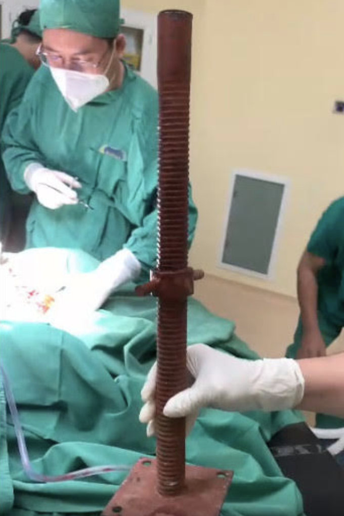 Ngã giàn công trình, nam thanh niên bị ống sắt đâm xuyên cổ kinh hoàng - 3