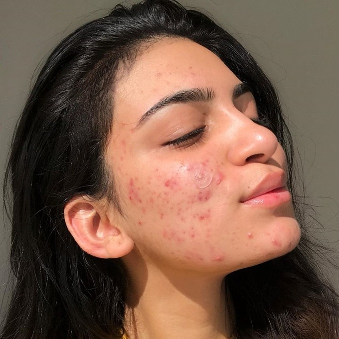 mun2acne-1673434284458.jpg