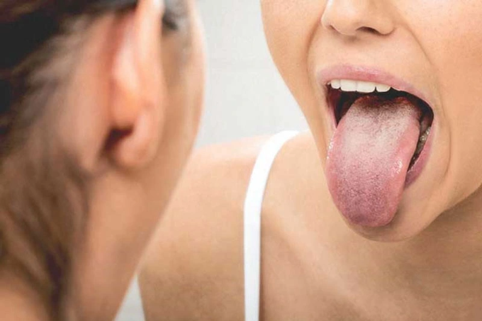 Bệnh ung thư lưỡi có lây không? - 1 Bệnh ung thư lưỡi có lây không? - 1
