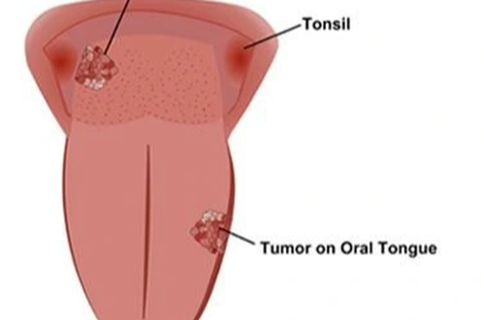 Rối loạn tiêu hóa dễ xảy ra sau khi ăn ở giai đoạn cuối của ung thư lưỡi?
