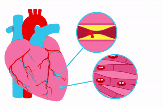 Khối mỡ nhỏ trong mạch máu có thể dẫn đến cái chết chớp nhoáng như thế nào? - 1