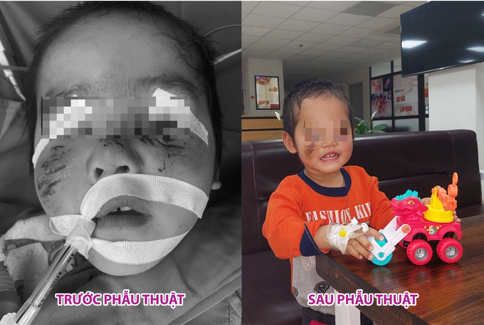 Sang nhà hàng xóm chơi, bé 3 tuổi bị chó cắn tổn thương nặng vùng mặt - 1 Sang nhà hàng xóm chơi, bé 3 tuổi bị chó cắn tổn thương nặng vùng mặt - 1