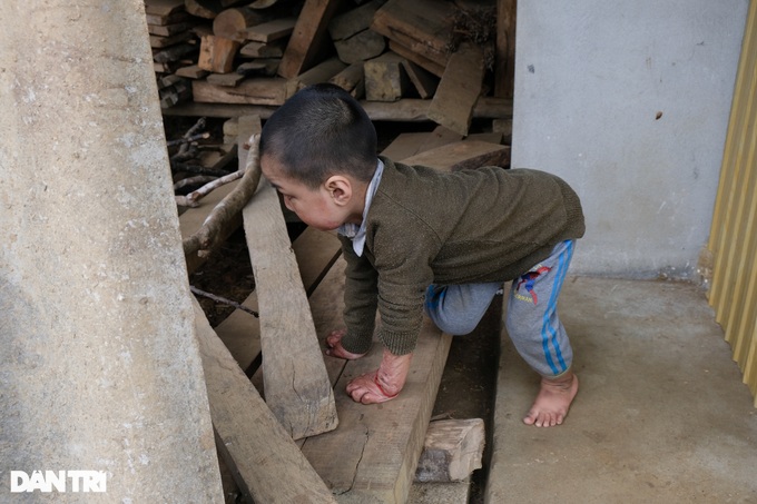 Cậu bé biến dạng khuôn mặt vì ngã vào nước nóng, gần 4 tuổi chưa biết nói - 8 Cậu bé biến dạng khuôn mặt vì ngã vào nước nóng, gần 4 tuổi chưa biết nói - 8