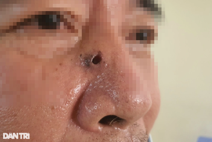 TPHCM: Lõm mũi, biến dạng mặt vì căn bệnh hiểm liên quan đến nắng nóng - 1