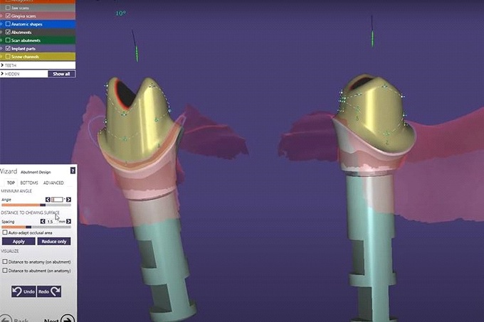 Công nghệ phục hình răng sứ trên implant DCT sắp có mặt tại Việt Nam - 1