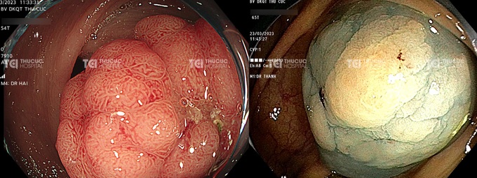 Nguy cơ ung thư đại tràng từ polyp bất thường | Báo Dân trí