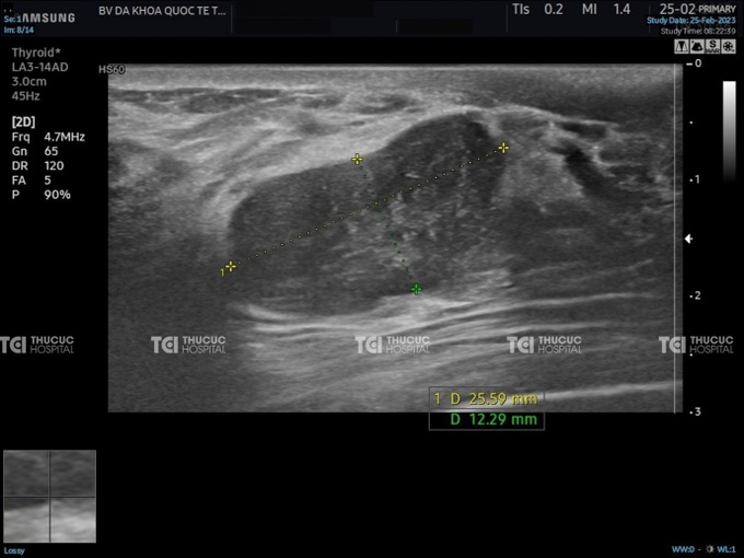 30 phút loại bỏ 14 khối u mọc như chùm nho ở ngực người phụ nữ - 1