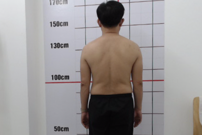 Thấy tê bì tay chân: Coi chừng liệt vận động, mất khả năng tình dục - 2 Thấy tê bì tay chân: Coi chừng liệt vận động, mất khả năng tình dục - 2