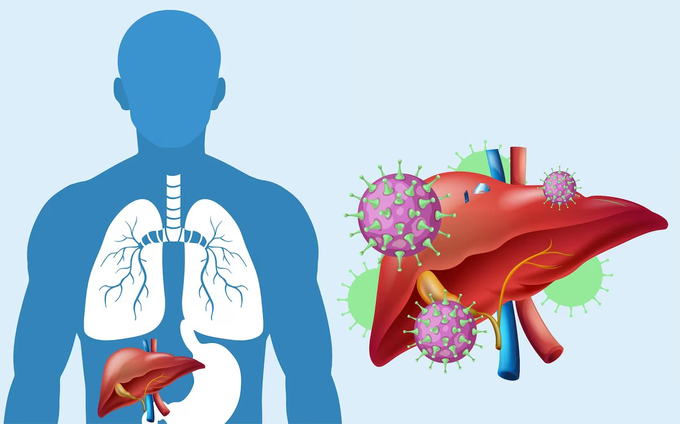 Bệnh viêm gan virus B mạn tính: Có thể điều trị khỏi - 2