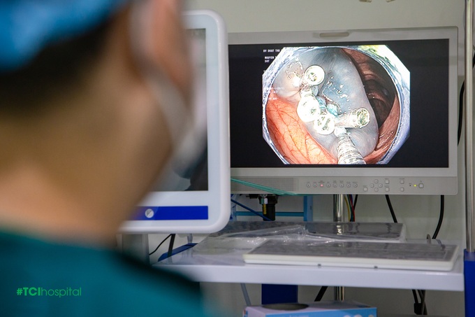 Nội soi dạ dày đại tràng - Khắc tinh của polyp đường tiêu hóa - 3 Nội soi dạ dày đại tràng - Khắc tinh của polyp đường tiêu hóa - 3