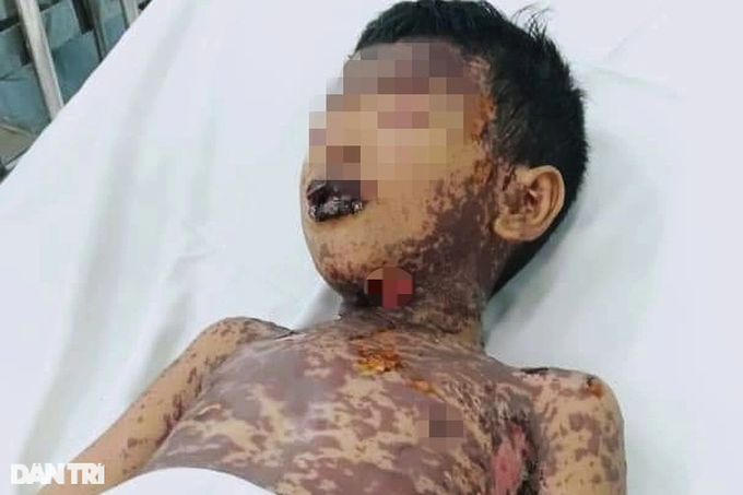 Bé trai lở loét vùng kín, nhiễm trùng nặng sau khi chích thuốc ở phòng khám - 2 Bé trai lở loét vùng kín, nhiễm trùng nặng sau khi chích thuốc ở phòng khám - 2