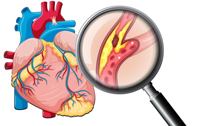 Khó nhận biết bệnh tim mạch vì dấu hiệu mờ nhạt - 2