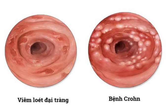 Hội chứng suy dinh dưỡng gây tử vong, 1 triệu dân chỉ 2 người mắc phải - 2