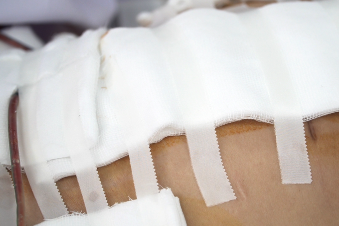 Người phụ nữ ở TPHCM hôn mê, mổ cấp cứu mất 6 lít máu sau khi đi hút mỡ - 1 Người phụ nữ ở TPHCM hôn mê, mổ cấp cứu mất 6 lít máu sau khi đi hút mỡ - 1