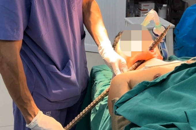 Thanh xà beng dài 90cm đâm xuyên cổ người bệnh - 1 Thanh xà beng dài 90cm đâm xuyên cổ người bệnh - 1